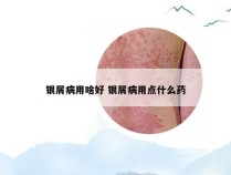 银屑病用啥好 银屑病用点什么药