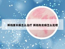 裤裆里长癣怎么治疗 裤裆有皮癣怎么处理