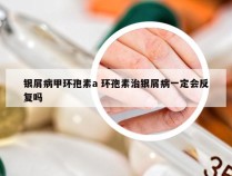 银屑病甲环孢素a 环孢素治银屑病一定会反复吗