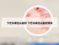 下巴长癣怎么能好 下巴长癣怎么能好得快