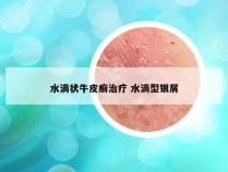 水滴状牛皮癣治疗 水滴型银屑