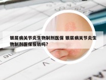 银屑病关节炎生物制剂医保 银屑病关节炎生物制剂医保报销吗?