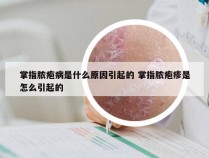 掌指脓疱病是什么原因引起的 掌指脓疱疹是怎么引起的