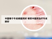 中医哪个牛皮癣医院好 哪家中医院治疗牛皮鲜好