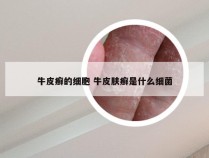 牛皮癣的细胞 牛皮肤癣是什么细菌