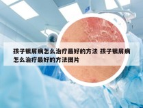 孩子银屑病怎么治疗最好的方法 孩子银屑病怎么治疗最好的方法图片