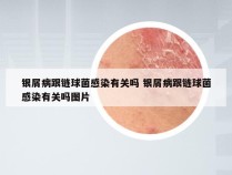 银屑病跟链球菌感染有关吗 银屑病跟链球菌感染有关吗图片