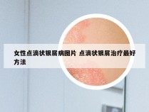 女性点滴状银屑病图片 点滴状银屑治疗最好方法