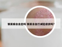 银屑癣会自愈吗 银屑会自行减轻症状吗?