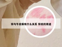 锌与牛皮癣有什么关系 锌皮的用途