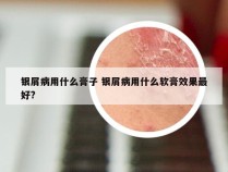 银屑病用什么膏子 银屑病用什么软膏效果最好?