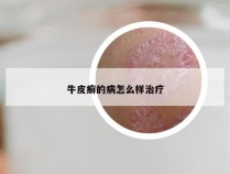 牛皮癣的病怎么样治疗