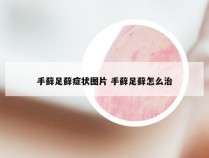 手藓足藓症状图片 手藓足藓怎么治