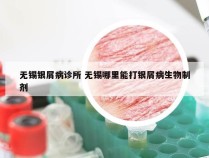 无锡银屑病诊所 无锡哪里能打银屑病生物制剂