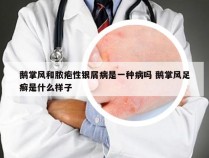 鹅掌风和脓疱性银屑病是一种病吗 鹅掌风足癣是什么样子