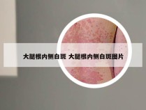 大腿根内侧白斑 大腿根内侧白斑图片