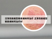 泛发性脓疱型银屑病如何治疗 泛发性脓疱型银屑病如何治疗好