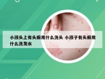 小孩头上有头癣用什么洗头 小孩子有头癣用什么洗发水