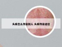 头癣怎么传染别人 头癣传染途径