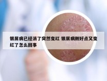 银屑病已经消了突然变红 银屑病刚好点又变红了怎么回事