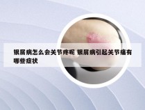 银屑病怎么会关节疼呢 银屑病引起关节痛有哪些症状