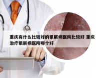 重庆有什么比较好的银屑病医院比较好 重庆治疗银屑病医院哪个好