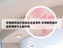 生物制剂治疗皮肤还会复发吗 生物制剂治疗皮肤病有什么副作用