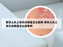 新生儿头上有头皮癣是怎么回事 新生儿头上有头皮癣是怎么回事啊