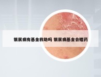 银屑病有基金救助吗 银屑病基金会赠药