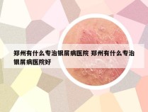 郑州有什么专治银屑病医院 郑州有什么专治银屑病医院好