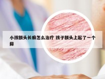 小孩额头长癣怎么治疗 孩子额头上起了一个藓