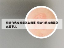 后脑勺头皮癣是怎么回事 后脑勺头皮癣是怎么回事儿