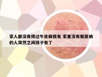 家人都没有得过牛皮癣我有 家里没有银屑病的人突然之间孩子有了