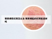 银屑病性红斑怎么治 银屑病起的红斑能退掉吗