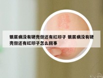 银屑病没有硬壳但还有红印子 银屑病没有硬壳但还有红印子怎么回事