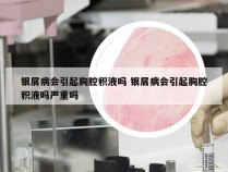 银屑病会引起胸腔积液吗 银屑病会引起胸腔积液吗严重吗