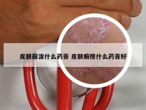 皮肤藓涂什么药膏 皮肤癣擦什么药膏好