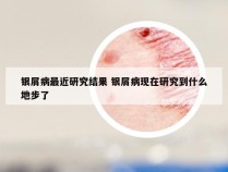 银屑病最近研究结果 银屑病现在研究到什么地步了