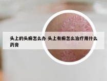 头上的头癣怎么办 头上有癣怎么治疗用什么药膏