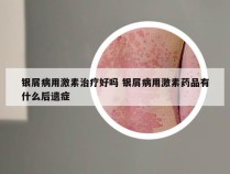 银屑病用激素治疗好吗 银屑病用激素药品有什么后遗症