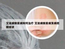 艾滋病银屑病如何治疗 艾滋病银屑病发病初期症状