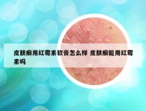 皮肤癣用红霉素软膏怎么样 皮肤癣能用红霉素吗