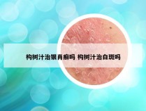 构树汁治银肖癣吗 构树汁治白斑吗