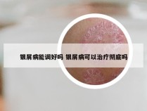 银屑病能调好吗 银屑病可以治疗彻底吗