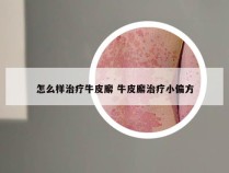 怎么样治疗牛皮廨 牛皮廨治疗小偏方