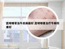 昆明哪家治牛皮癣最好 昆明哪里治疗牛癣效果好