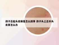 孩子总起头皮癣是怎么回事 孩子头上总长头皮屑怎么办