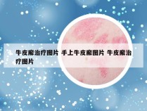 牛皮廨治疗图片 手上牛皮廨图片 牛皮廨治疗图片