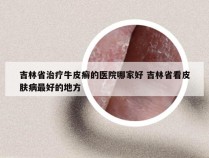 吉林省治疗牛皮癣的医院哪家好 吉林省看皮肤病最好的地方