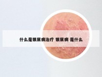 什么是银屑病治疗 银屑病 是什么